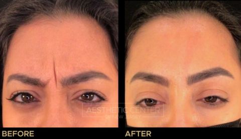 Before and after result of a woman who received a Botox/Xeomin treatment for her frown lines.