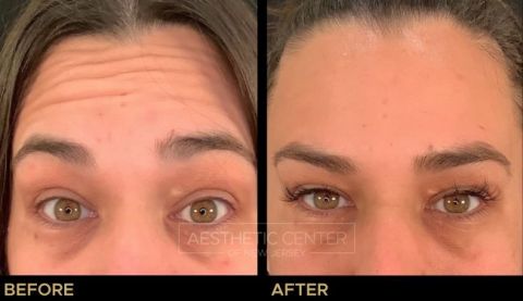 Before and after result of a woman who received a Botox/Xeomin treatment for her forehead lines.
