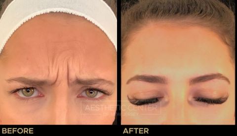 Before and after result of a young woman who received a Botox/Xeomin treatment for her frown lines.