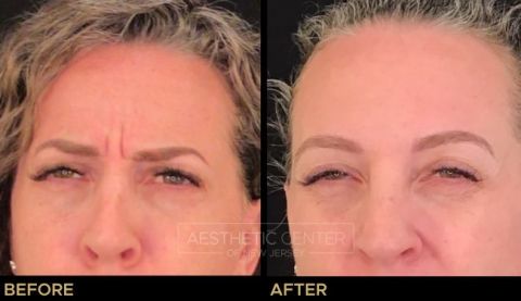 Before and after result of a woman who received a Botox/Xeomin treatment for her frown lines.