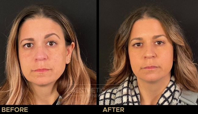 Before and after result of a woman who received a Botox/Xeomin treatment for her forehead lines and correction of brow asymmetry.