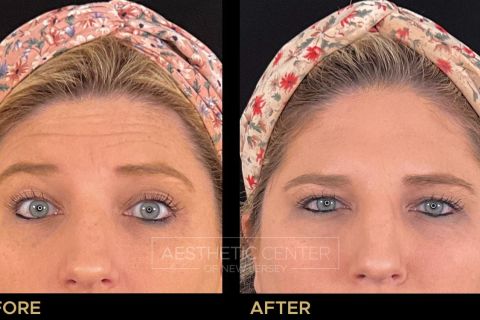Before and after result of a woman who received a Xeomin treatment for her forehead lines.