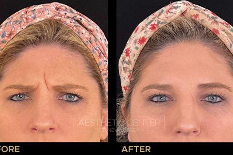 Before and after result of a woman who received a Xeomin treatment for her frown lines.
