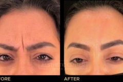 Before and after result of a woman who received a Botox/Xeomin treatment for her frown lines.