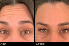Before and after result of a woman who received a Botox/Xeomin treatment for her forehead lines.