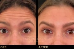 Before and after result of a young woman who received a Botox/Xeomin treatment for her forehead lines.