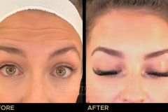 Before and after result of a young woman who received a Botox/Xeomin treatment for her forehead lines.