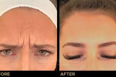 Before and after result of a young woman who received a Botox/Xeomin treatment for her frown lines.