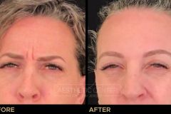 Before and after result of a woman who received a Botox/Xeomin treatment for her frown lines.