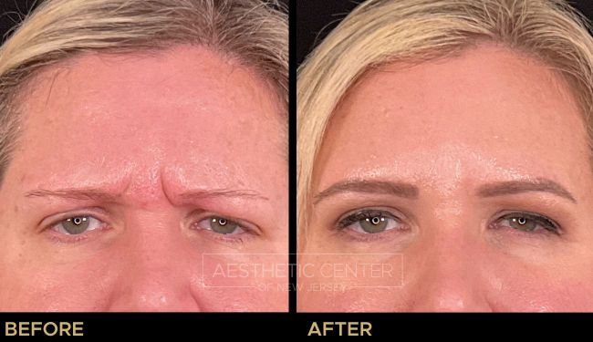 Before and after result of a woman who received a Botox/Xeomin treatment for her frown lines.