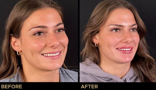 Before and after result of a young woman who received a Botox/Xeomin treatment for her forehead lines and brow lift.