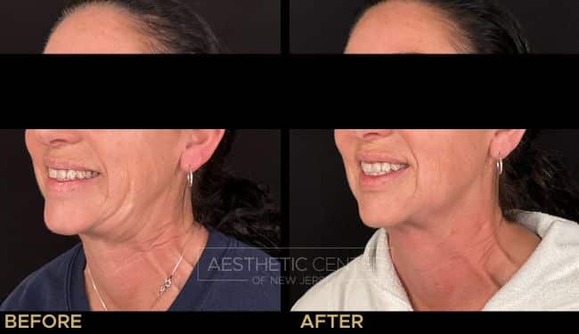 Before and after of full face and full neck Botox (neuromodulator) for a smoothing and tightening effect.