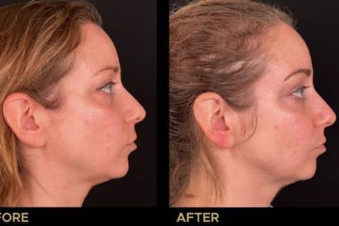 Nefertiti Lift on Neck/Jawline with Botox/Xeomin.