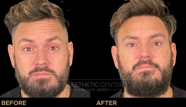 Before and after result of a man who received a Botox/Xeomin treatment for his forehead lines.