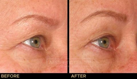 Ultherapy brow lift before and after result on woman, 45 degree view.