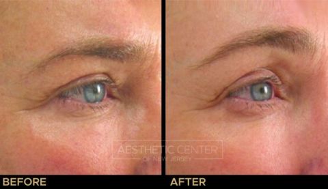 Ultherapy brow lift before and after result on woman, 45 degree view.