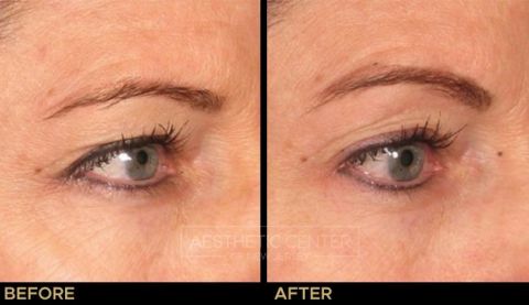 Ultherapy brow lift before and after result on woman, 45 degree view.