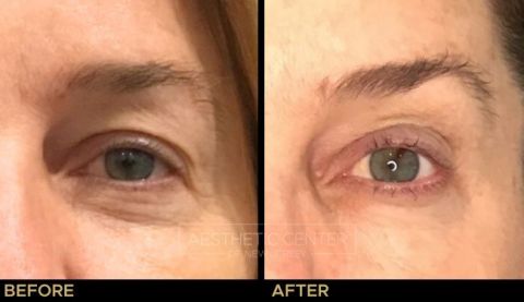 Ultherapy brow lift before and after result on woman, front view.