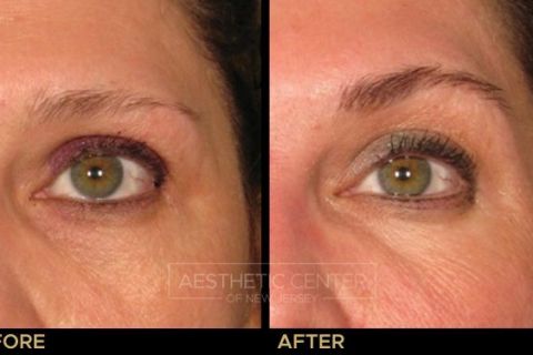 Ultherapy brow lift before and after result on woman, front view.