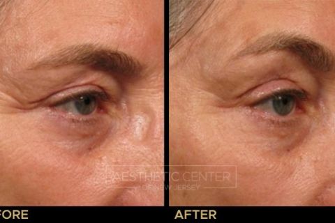 Ultherapy brow lift before and after result on woman, 45 degree view.