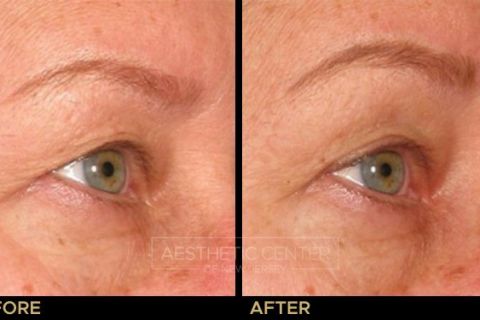 Ultherapy brow lift before and after result on woman, 45 degree view.