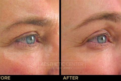 Ultherapy brow lift before and after result on woman, 45 degree view.