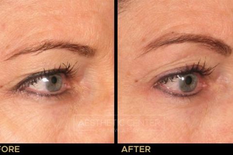 Ultherapy brow lift before and after result on woman, 45 degree view.