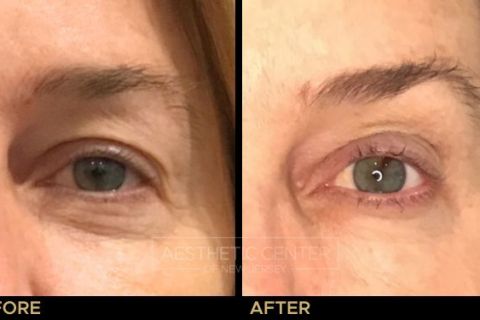 Ultherapy brow lift before and after result on woman, front view.
