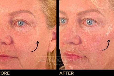 Cheek filler to add  contour to the face.