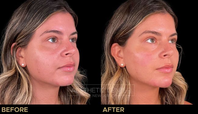 Cheek filler as part of a facial balancing treatment to  contour the face.