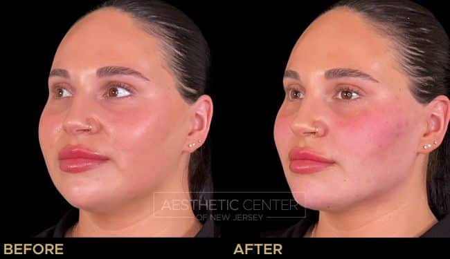 Cheek filler as part of a facial balancing treatment to lift and contour the face.