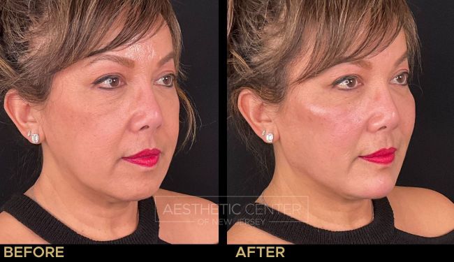 Cheek filler as part of a facial balancing treatment to lift and contour the face.