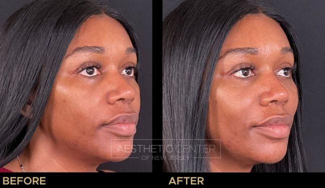 Cheek filler  treatment to lift and contour the face.