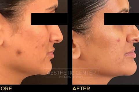 Website B&A Gallery - S. Patel -Hyperpigmentation  (2)