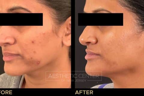 Website B&A Gallery - S. Patel -Hyperpigmentation