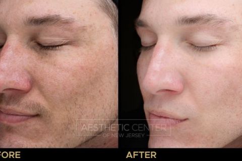 VI Peel B&A - 3