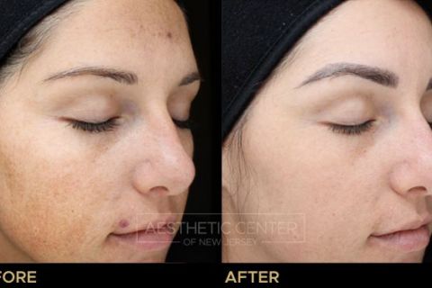 VI Peel B&A - 1