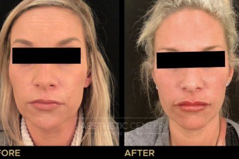 Facial Balancing with Filler