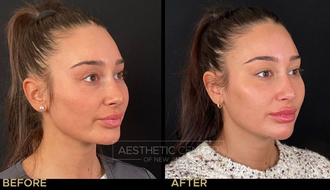 Before and after of facial contouring enhancement and lip filler on a female.