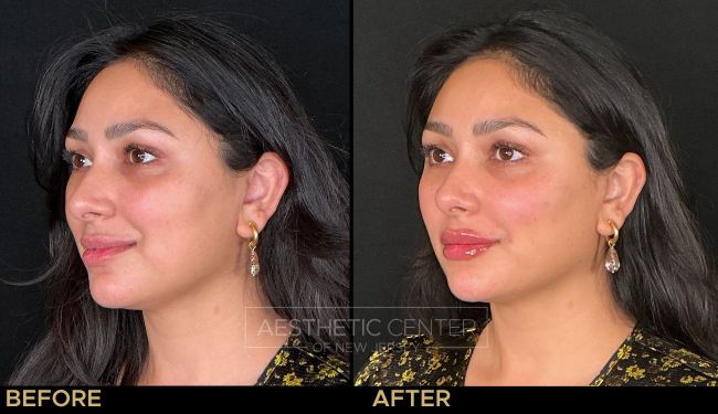 Facial balancing and lips with filler.
