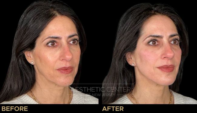 Facial Balancing with Filler focused on natural rejuvenation and anti-aging.