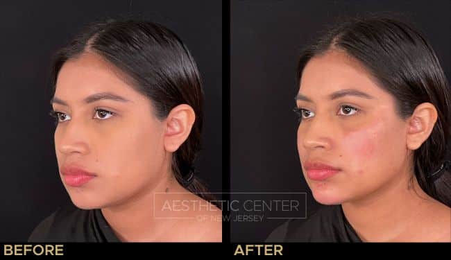 Facial Balancing with Filler focused on slimming and contour.