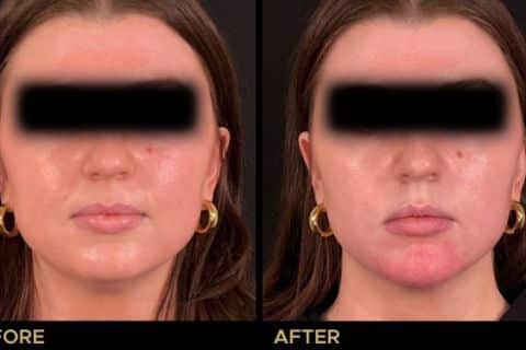 Facial Balancing with Filler focused on the Chin area.