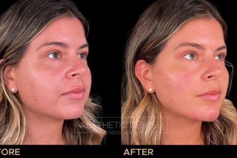 Facial Balancing with Filler focused on slimming.