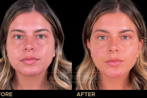 Facial Balancing with Filler focused on slimming.