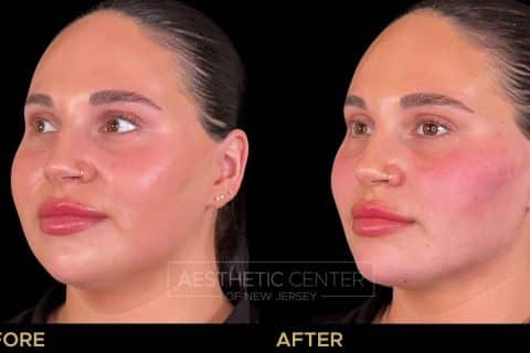 Facial Balancing with Filler focused on slimming and contour.