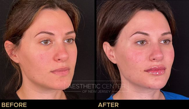 Facial Balancing with Filler focused on the overall contour and balance.