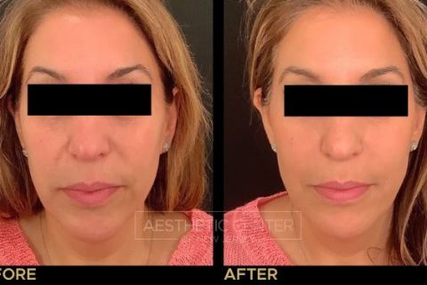 Facial Balancing with Filler