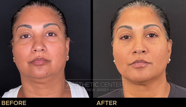 Facial Balancing with Filler focused on overall balance and slimming.