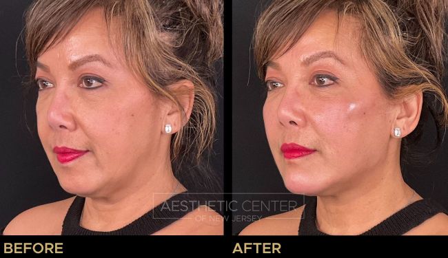 Facial Balancing with Filler focused on overall contour, proportion, and balance.